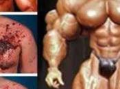 Abuso esteroides hormonas