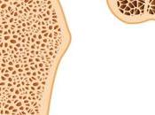 osteoporosis salud ósea