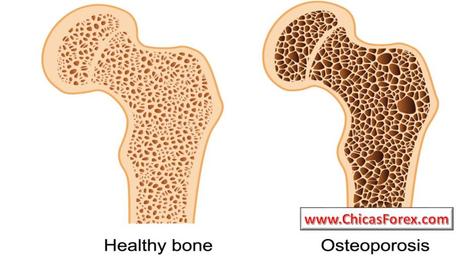 La osteoporosis y la salud ósea La osteoporosis y la salud ósea