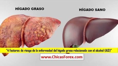 4 Factores de riesgo de la enfermedad del hígado graso relacionada con el alcohol (ALD)