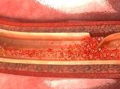 saber sobre disección aórtica