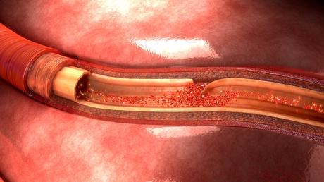 Lo que hay que saber sobre la disección aórtica El dolor severo en el abdomen es un síntoma potencial de la disección aórtica