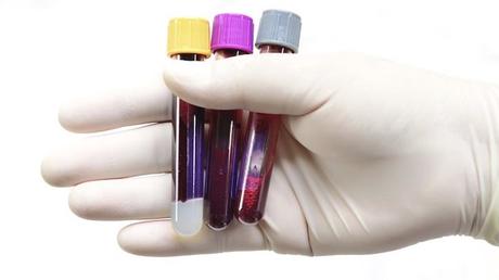 La hepatitis es una infección viral que afecta al hígado.