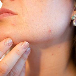 Cómo tratar cicatrices de acné profundas
