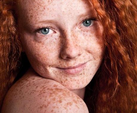 Qué saber sobre las pecas La exposición al sol y la genética pueden causar pecas
