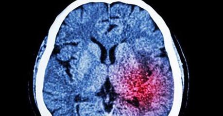 El ictus también afecta a los jóvenes Ictus: síntomas y tratamiento