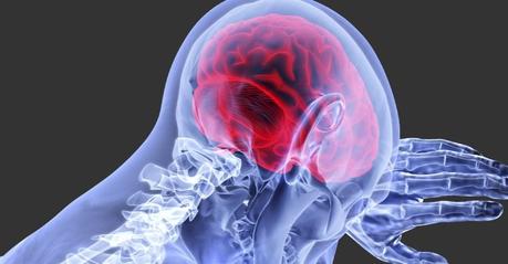 El ictus también afecta a los jóvenes Ictus en jóvenes