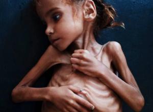 Murió Amal Hussain, niña símbolo de la hambruna en Yemen y del cinismo del Primer Mundo