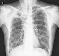 La Tuberculosis Pulmonar se puede curar con un Tratamiento más corto