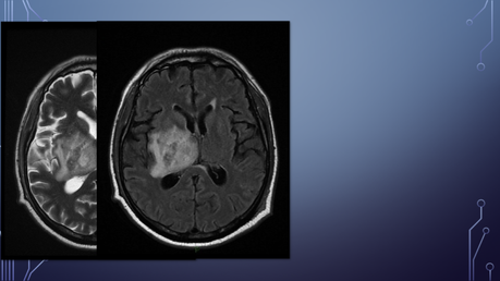 CASO CLINICO DE NEUROLOGIA CEREBRITIS Y ABSCESO CEREBRAL