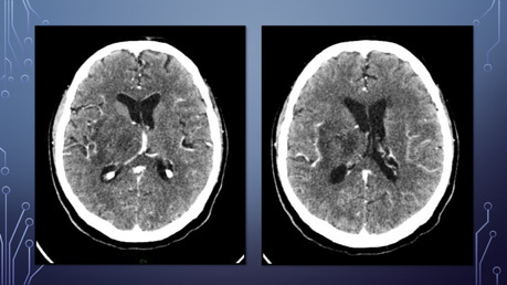 CASO CLINICO DE NEUROLOGIA CEREBRITIS Y ABSCESO CEREBRAL