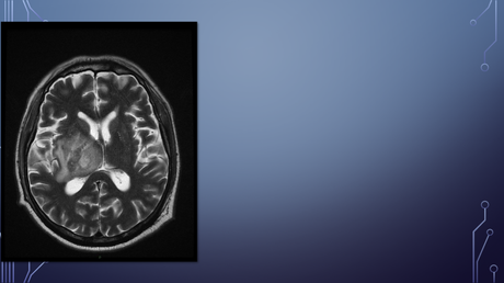 cerebritis temprana por resonancia magnetica