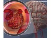 Momento anticoagulación después accidente cerebrovascular isquémico reciente pacientes fibrilación auricular.