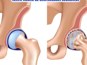 Artricenter: osteoartrosis cadera