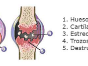 Artricenter: Evolución osteoartrosis