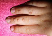 Verrugas en las manos y los pies: Consejos comunes para la eliminación de verrugas, remedios caseros y tratamientos