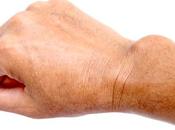 Calcificación: causas, síntomas, prevención tratamiento depósitos calcio