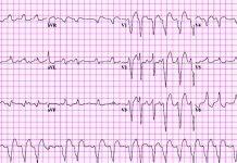 Síndrome De Wolff Parkinson White y ECG