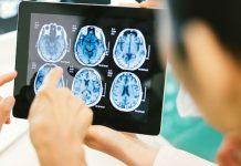 5 cosas que debe saber después de haber tenido un accidente cerebrovascular o que haya tenido un ser querido