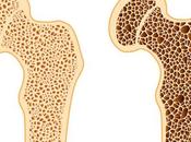Osteoporosis: ¿Podrían probióticos proteger salud ósea?