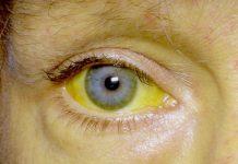 Razones por las que tus ojos pueden volverse amarillos