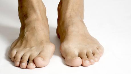 Cómo tratar los juanetes: remedios caseros y cirugía