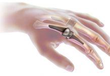 ¿Es usted un candidato para la cirugía de reemplazo de nudillo?