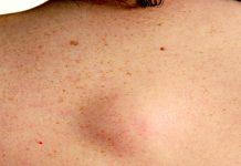 Bultos y protuberancias en su espalda: cuando debe preocuparse