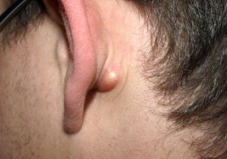 Bultos detrás de la oreja Bultos detrás de la oreja