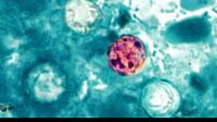 La Ciclosporiasis