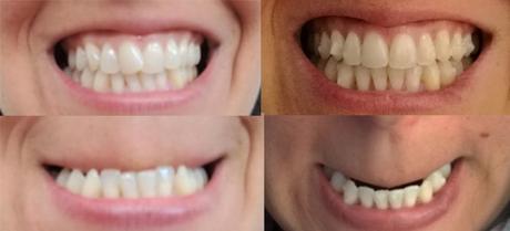 Mi experiencia: Llevar invisalign estando embarazada. ¿Es compatible? ¿Es cómodo?