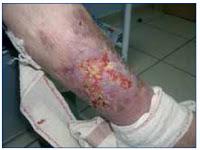 La Calcifilaxis o Arteriolopatía Urémica Calcificante