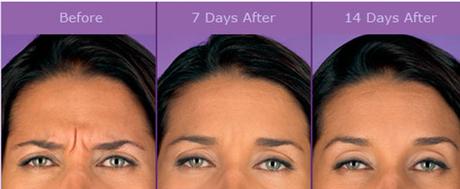 Tóxina Botulímica Navidad Tóxina Botulímica Navidad