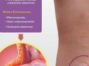 Hernia umbilical