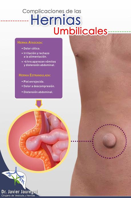 Hernia umbilical Hernia umbilical