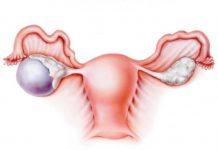 Tratamiento de quistes dermoides con y sin cirugía Tratamiento de quistes dermoides con y sin cirugía