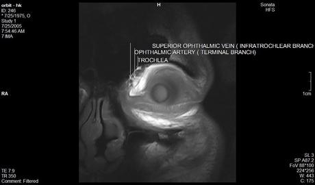 Anatomía de la órbita por resonancia magnética