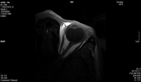 Anatomía de la órbita por resonancia magnética