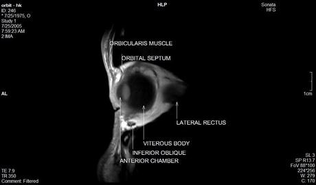 Anatomía de la órbita por resonancia magnética