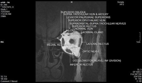 Anatomía de la órbita por resonancia magnética