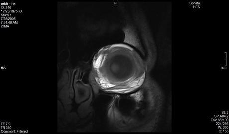 Anatomía de la órbita por resonancia magnética