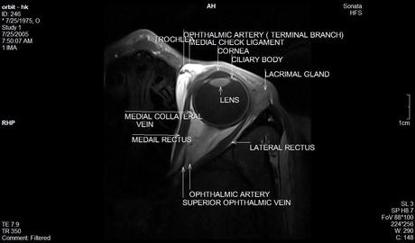 Anatomía de la órbita por resonancia magnética