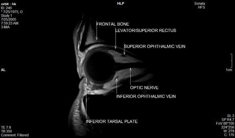 Anatomía de la órbita por resonancia magnética