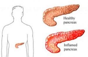 Cómo actuar ante una pancreatitis