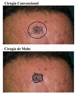 Xanit Hospital Internacional incorpora la cirugía de Mohs, una técnica segura y con un éxito casi del 100%, en el tratamiento del cáncer de piel
