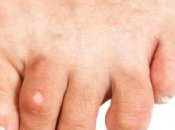 Cuando operarse juanetes