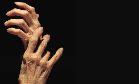 Artricenter: 4 datos rápidos de la artritis reumatoide Artricenter: 4 datos rápidos de la artritis reumatoide