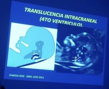 Medición de la translucencia nucal Medición de la translucencia nucal