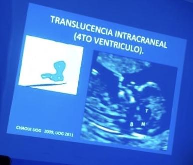 Medición de la translucencia nucal Medición de la translucencia nucal
