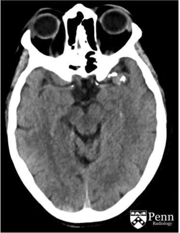 Caso clínico aneurisma de la arteria cerebral media segmento M2